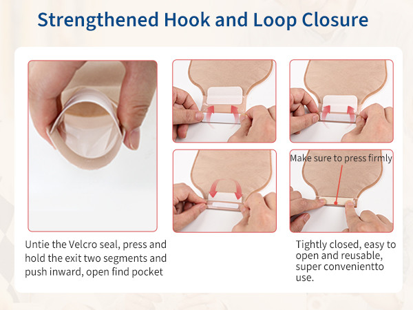 کیسه استومی