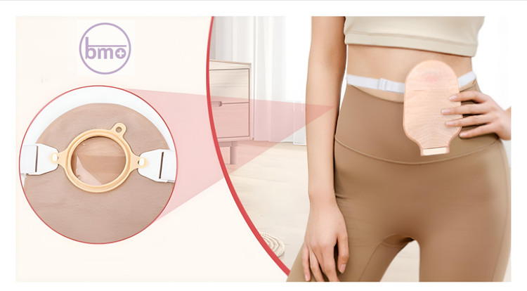 کیسه کلستومی