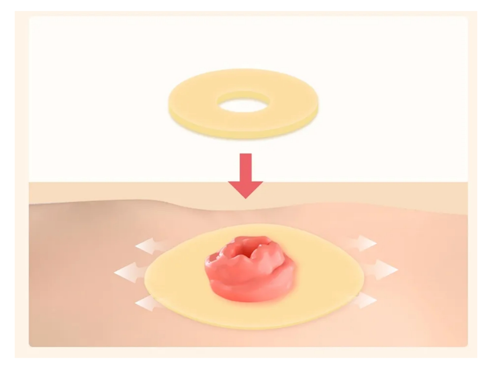 رینگ محافظ استومی