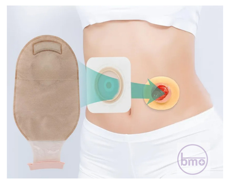 حلقه (رینگ) محافظ استومی هیدروکلوییدی Welland مدل HWA300 – سایز کوچک