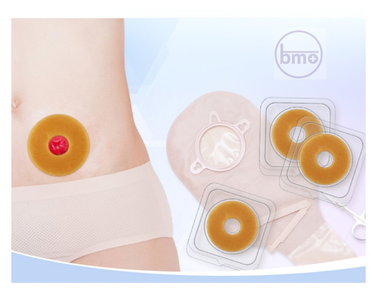 حلقه (رینگ) محافظ استومی هیدروکلوییدی Welland مدل HWA300 – سایز کوچک