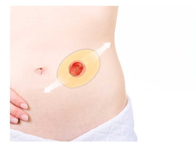 حلقه (رینگ) محافظ استومی هیدروکلوییدی Welland مدل HWA300 – سایز کوچک